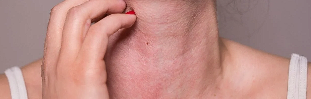 Cum stii ca suferi de o alergie alimentara. Primele simptome, la ce trebuie sa fim atenti