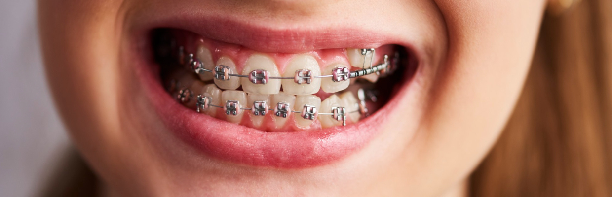 Aparat dentar: Ghid complet pentru pacienții care optează pentru el