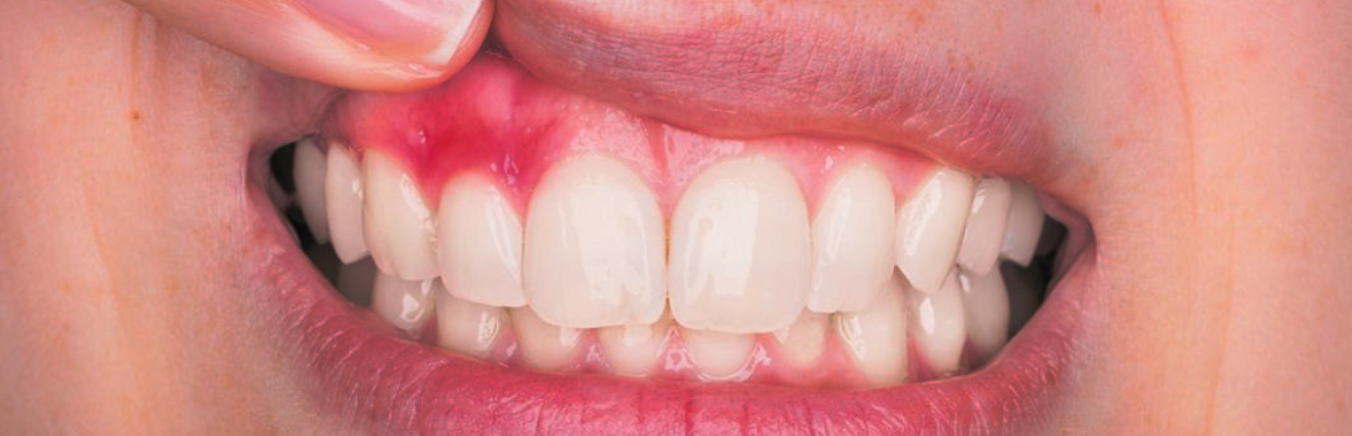 Dr. Alina Pripici: Inflamația gingivală, primul semn că organismul îmbătrânește mai repede decât ar trebui