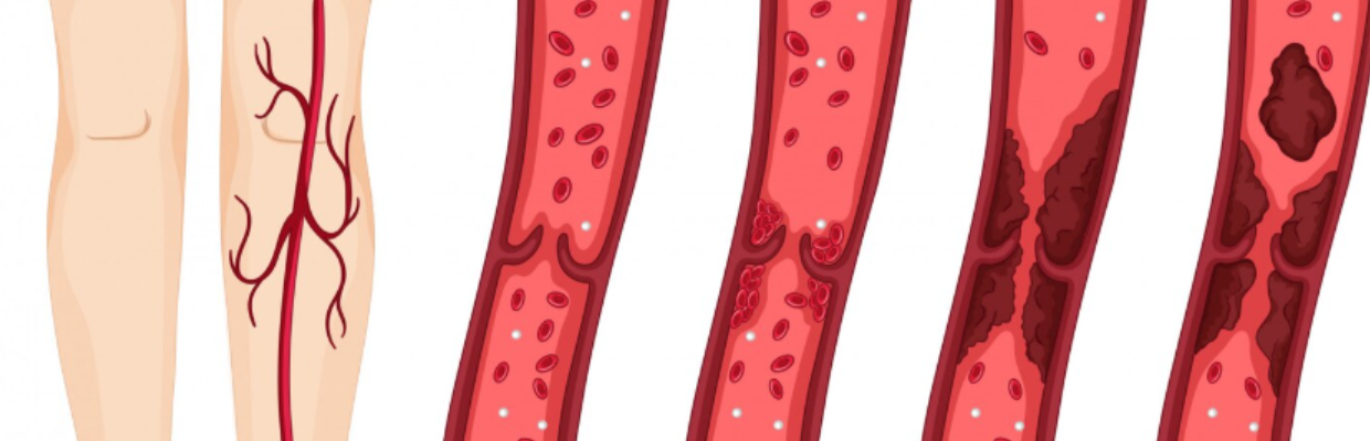 Arteriopatiile periferice: Cauze, care sunt simptomele, prevenție și tipuri de tratament