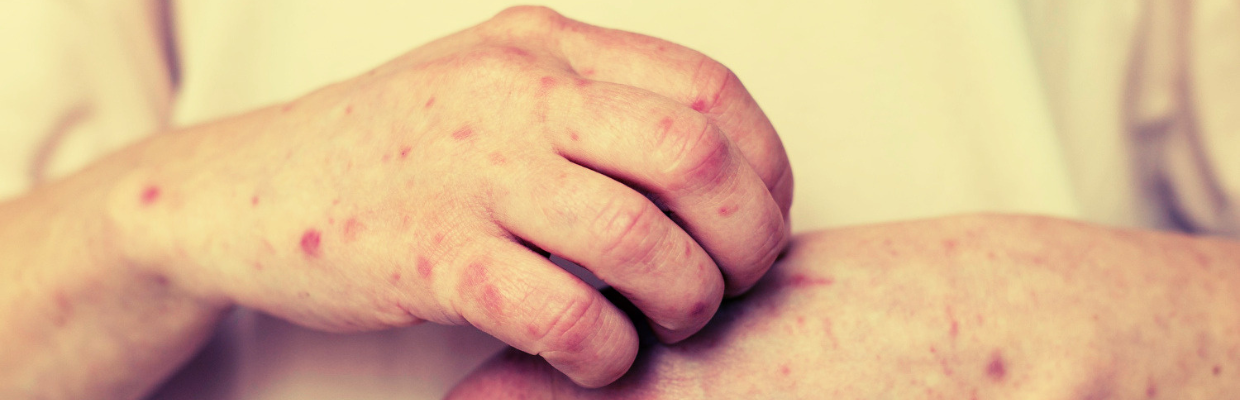 Eritrodermia: Cum identifici aceasta boala, preventie si optiuni de tratament