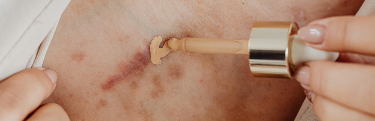 Tips and tricks: Cum poti scapa de cicatrici