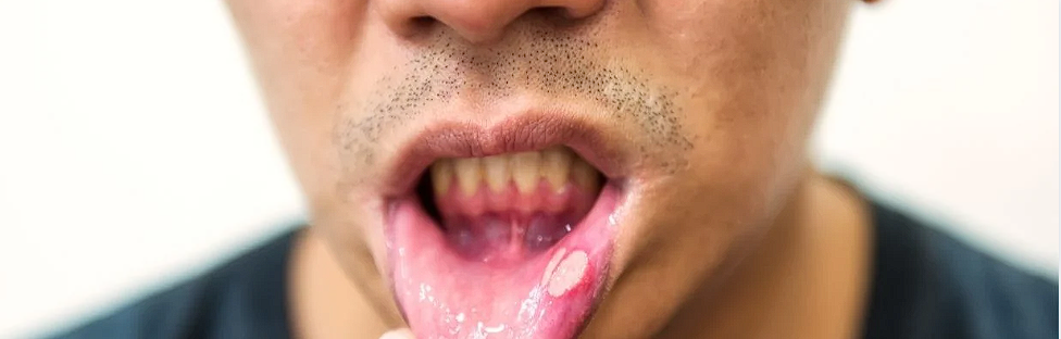 Igiena orala: Cand trebuie sa folosim dusul bucal, ce trebuie sa stim