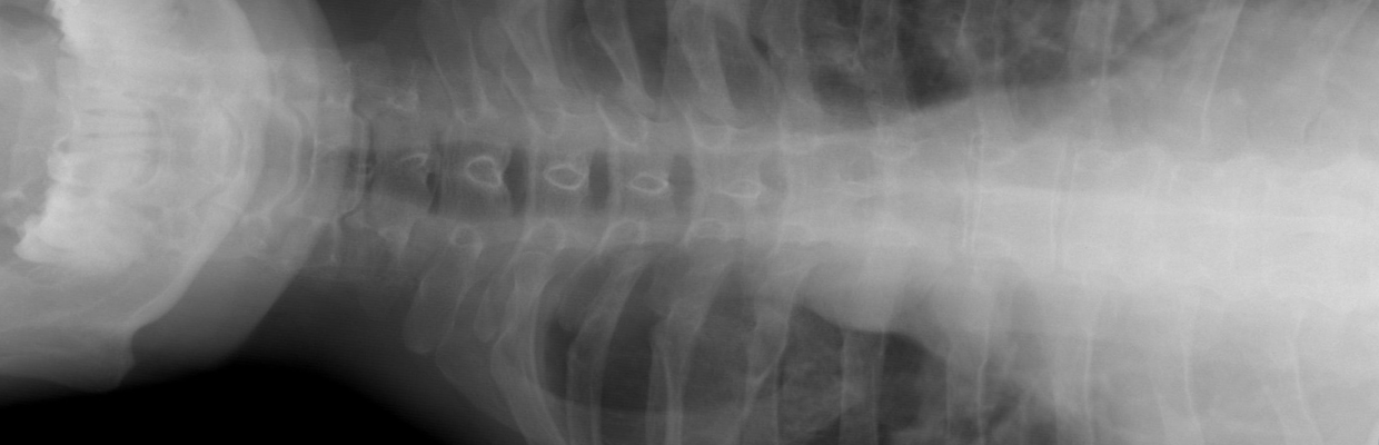 Anatomie: Ce este mediastinul si care este importanta lui pentru organism