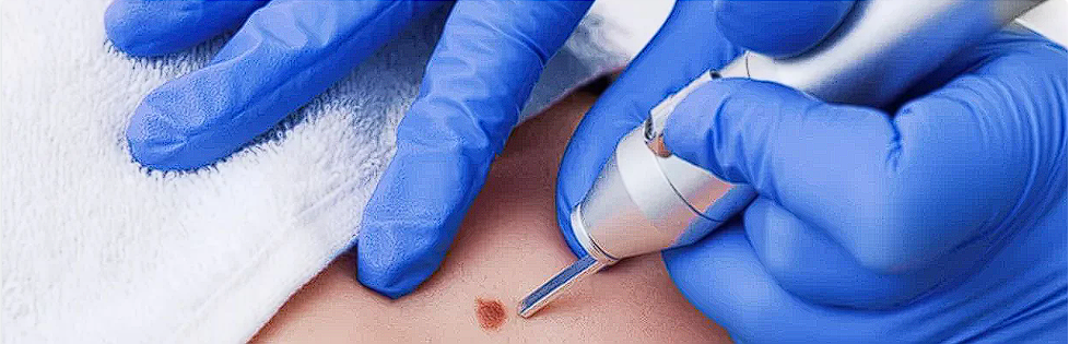 Osteonecroza: Simptome, diagnostic si tratament