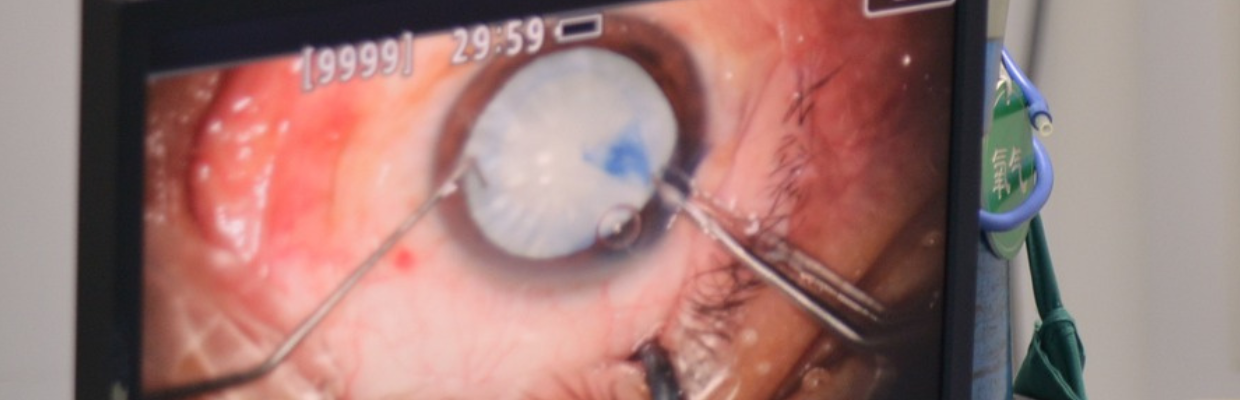 Pinguecula: De ce apare depozitul de proteine, grasimi sau calciu pe conjunctiva. Cum se poate preveni