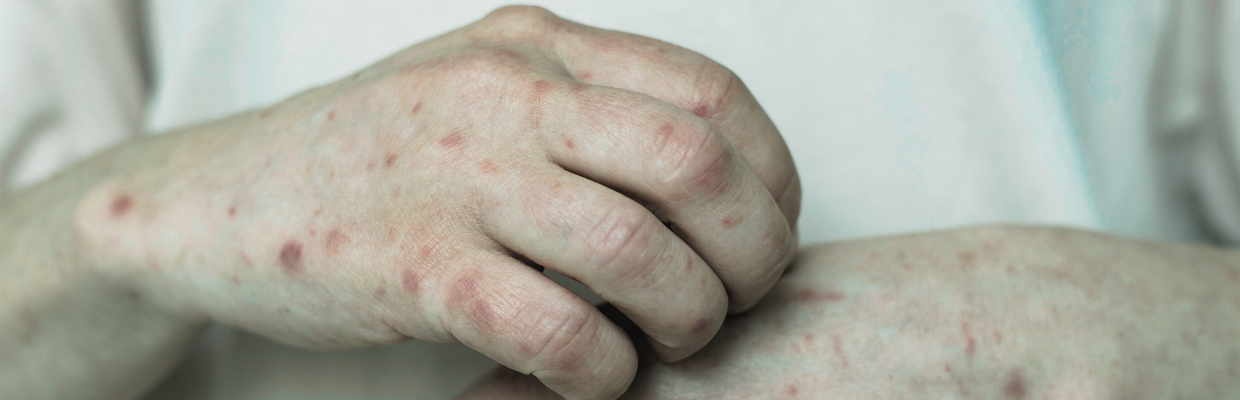 Impetigo sau bube dulci: De ce apare boala, simptome, diagnosticare si tipuri tratament
