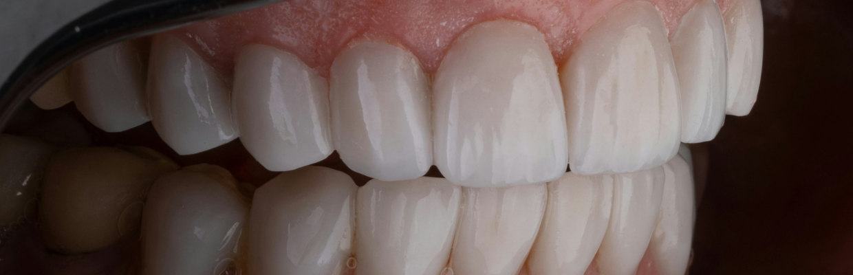 Dantura din zirconiu: Cand se recomanda folosirea ei, ce trebuie sa stim inainte de implant