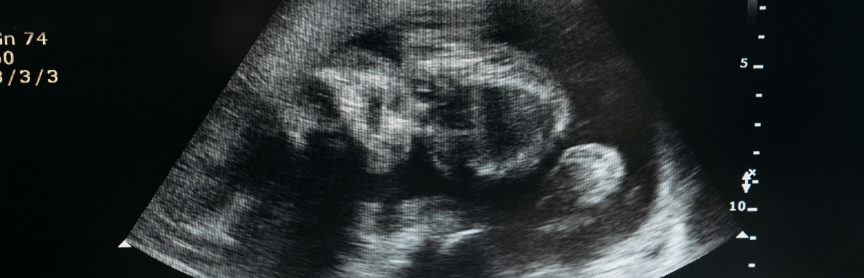 Sindromul alcoolic fetal: De ce apare, cum recunosti simptomele si cum se poate preveni