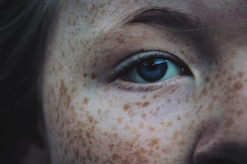 Melasma: De ce apare si cum se poate trata 