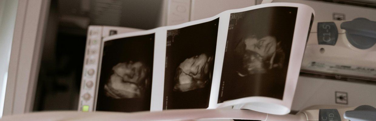 Sarcina gemelara: Cum se pune diagnostic, complicatii ale acestui tip de sarcina