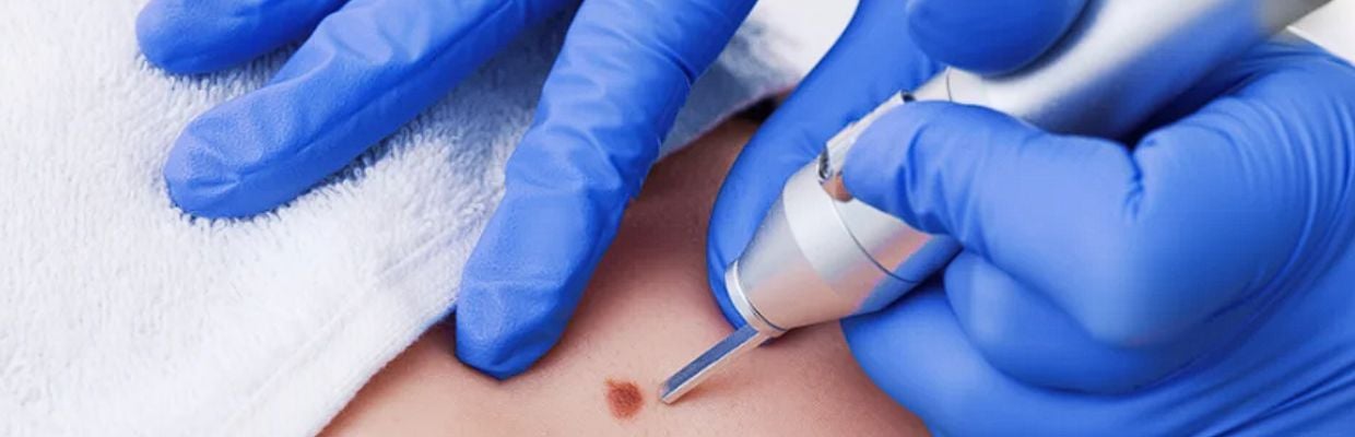 Melanomul: Ce este, cum se poate evita, complicatii ale cancerului de piele