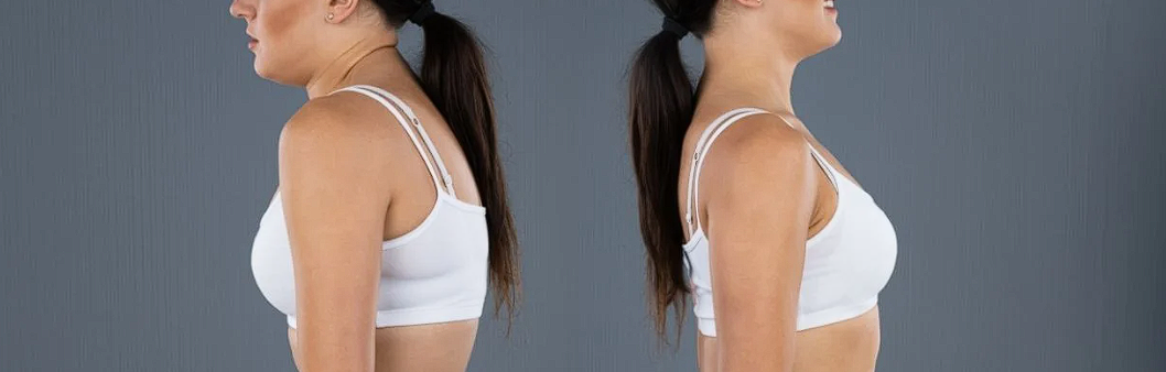 Sindromul Marfan: simptome, diagnostic si tratament