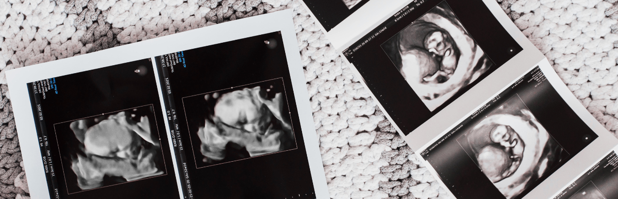 Prezentatia pelviana: Ce trebuie sa stii despre aceasta situatie care poate aparea in timpul evolutiei sarcinii