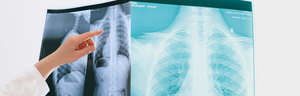 Pneumonia virala: De ce apare aceasta afectiune, cum o putem preveni, tipuri de tratament