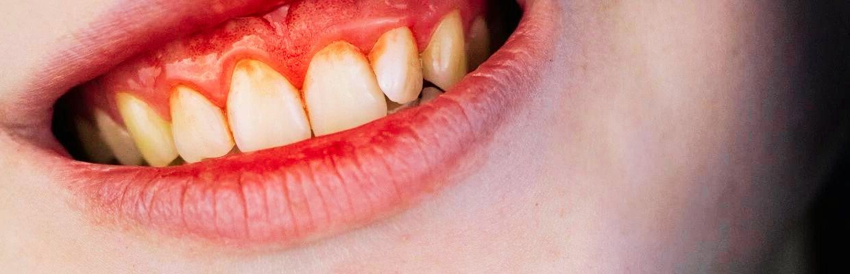 Afectiuni ale gingiilor: cum sa le prevenim, metode de tratament