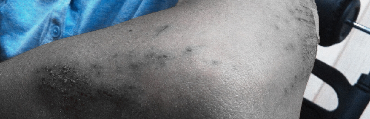 Telangiectazii: Ce trebuie sa stim despre aceasta afectiune vizibila la nivelul pielii