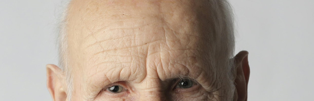 Alopecia areata: De ce apare, factori de risc, cum se poate preveni