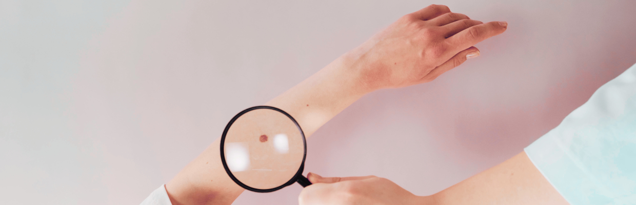 Carcinomul spinocelular: Ce trebuie sa stii despre acest tip de cancer de piele