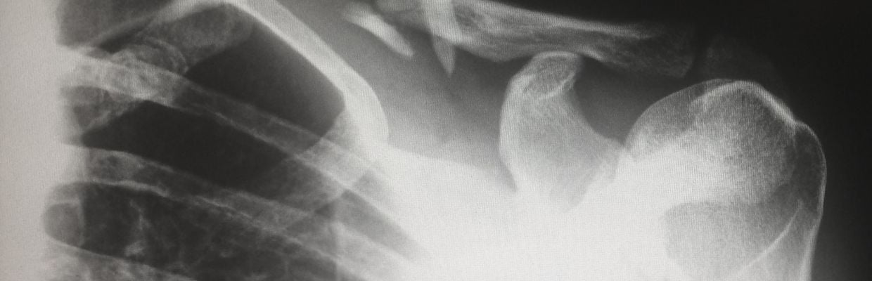 Clavicula: rol in organism, afectiuni, boli asociate