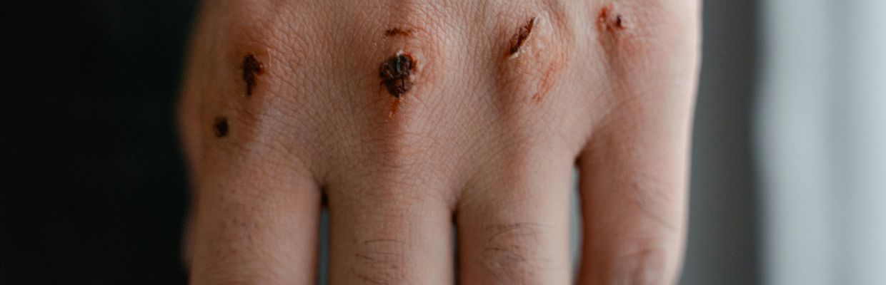 Dermatofibromul: cauze, simptome si tipuri de tratament