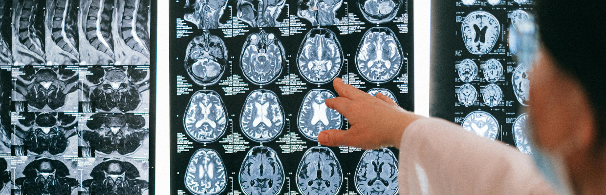 Nicergolina: Cum ajuta aceasta substanta la functionarea emisferelor cerebrale