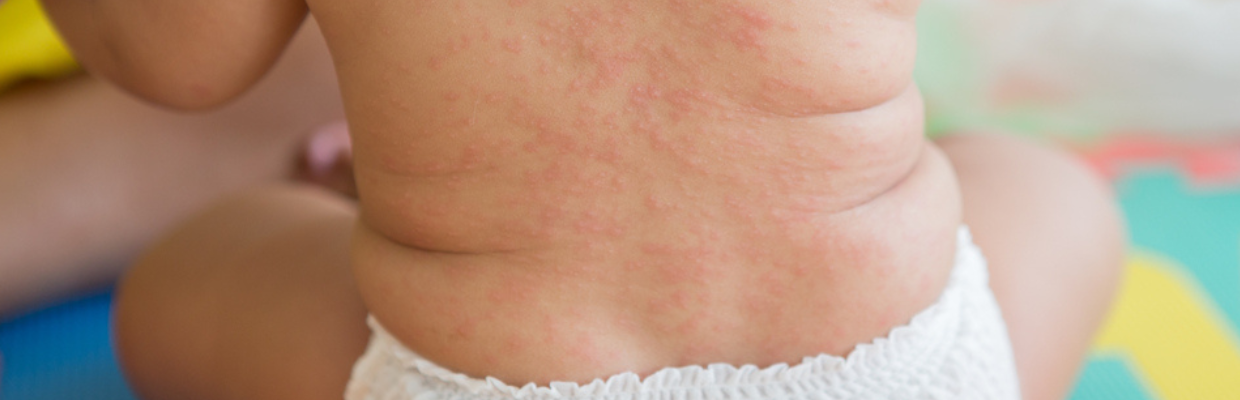 Roseola infantum: cauze, simptome, recomandari