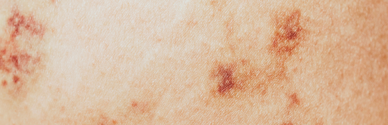 Urticaria presionala: De ce apare, cum o putem evita, tipuri de tratament