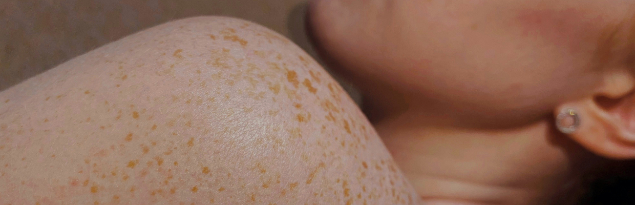 Psoriazisul pustular: cauze, simptome si optiuni de tratament