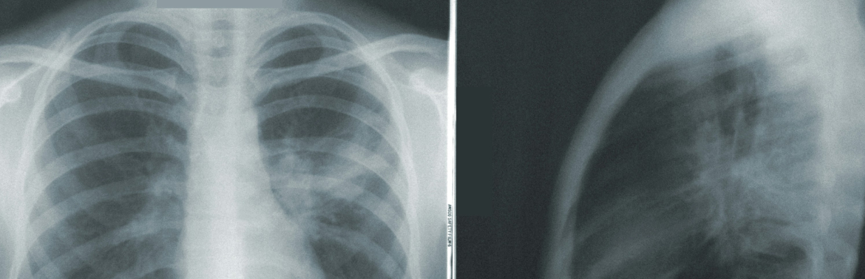 Radiografia toracica:  Cand se recomanda aceasta metoda de investigatie, ce trebuie sa stim