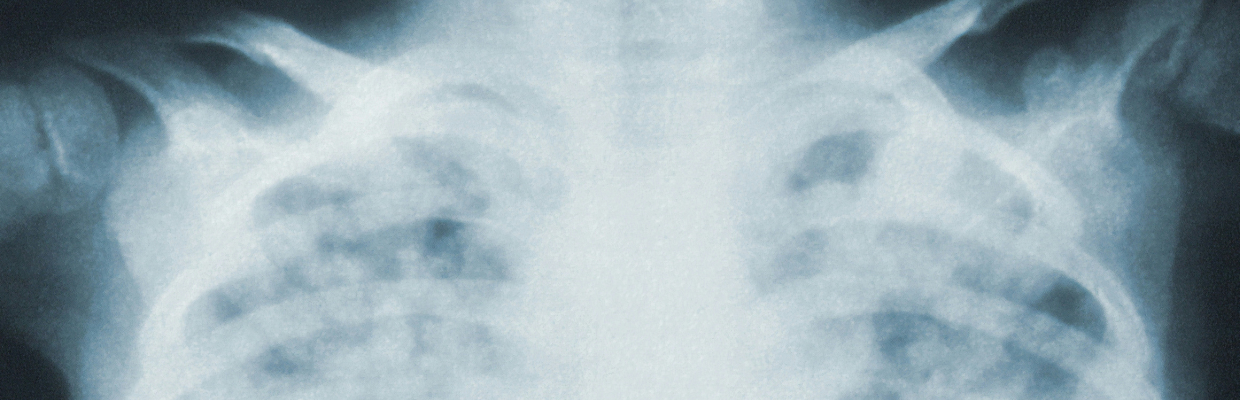 Pneumonita: tipuri, cauze, simptome si optiuni de tratament