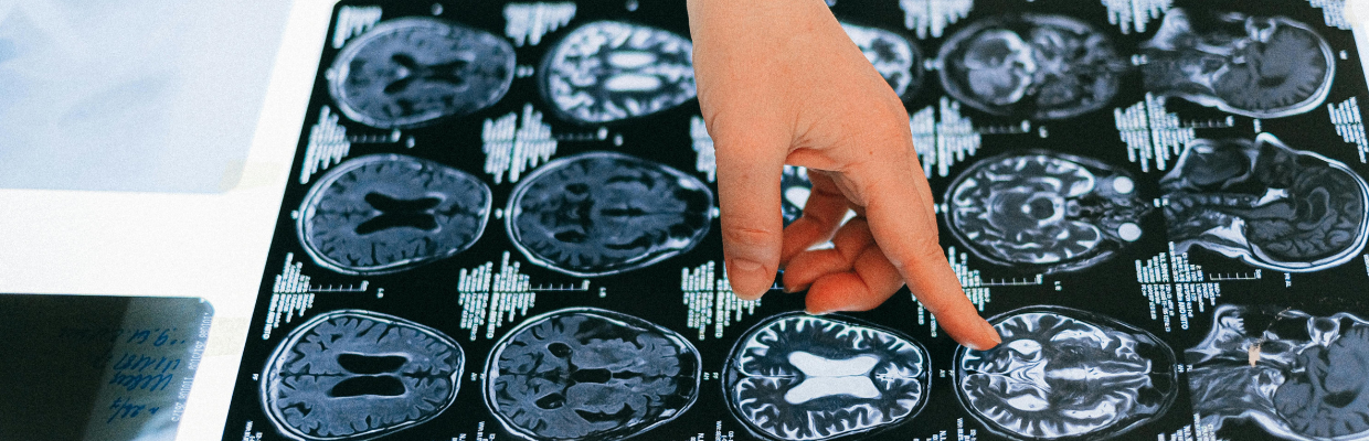 Arteriografia periferica: Ce este si cand se recomanda pentru diagnosticarea si tratarea bolilor vasculare