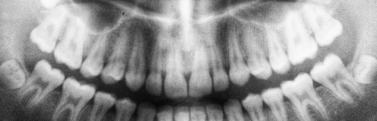 Fracturile dentare: De ce apar, simptome si tipuri de tratament