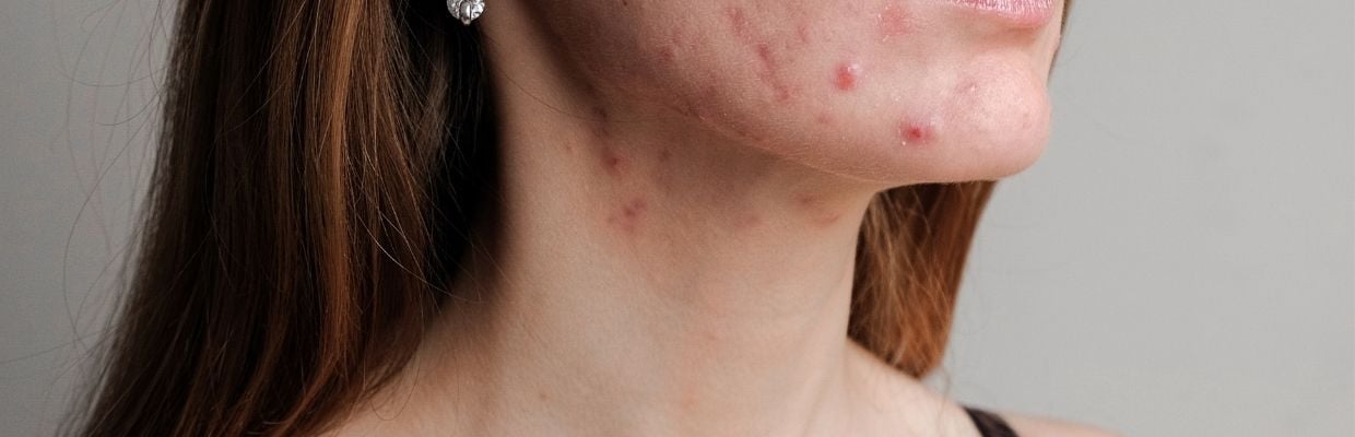 Acneea: cauze, tipuri, tratament, preventie