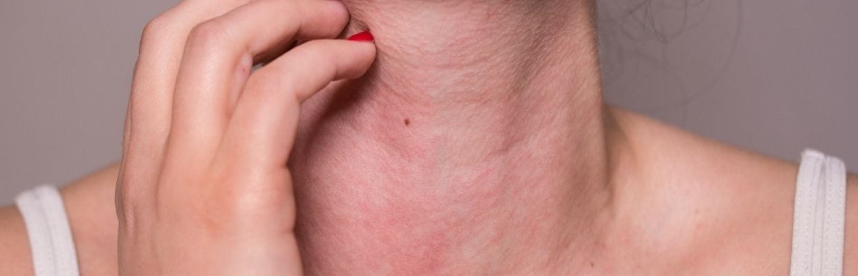 Alergia la Soare, eruptia polimorfa la lumina: cauze si tratament