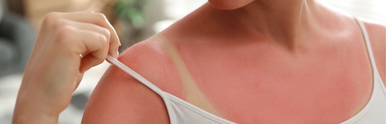 Arsurile solare: cum sa te protejezi si cum se trateaza