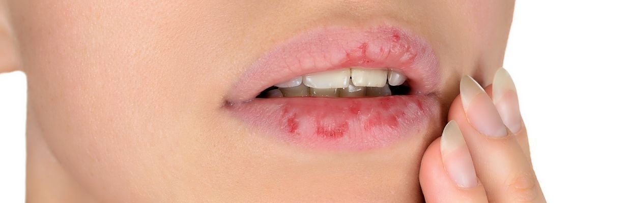 Buze uscate sau crapate: cauze, remedii, preventie