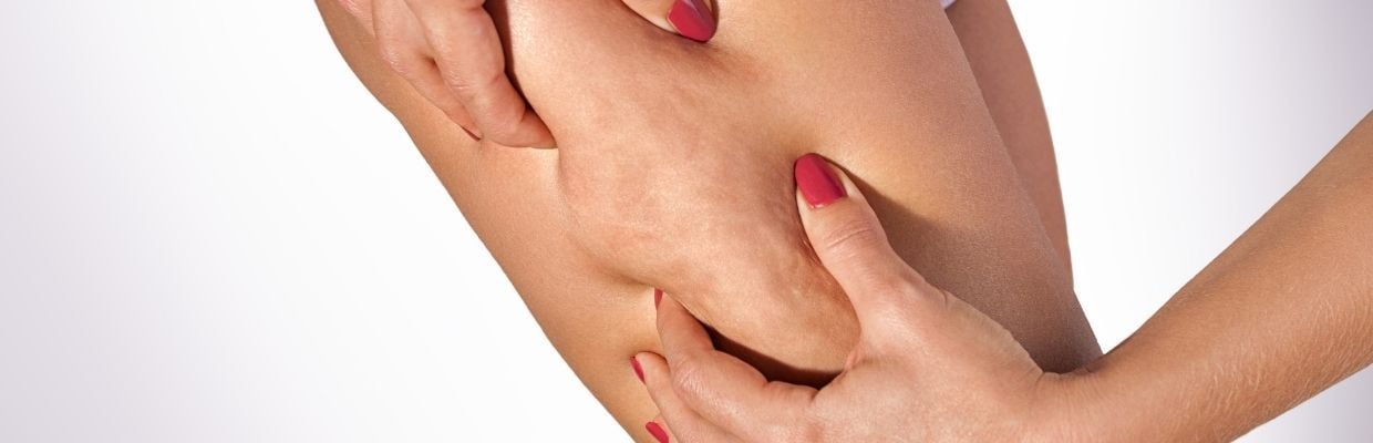 Celulita: de ce apare, tipuri si metode de tratament