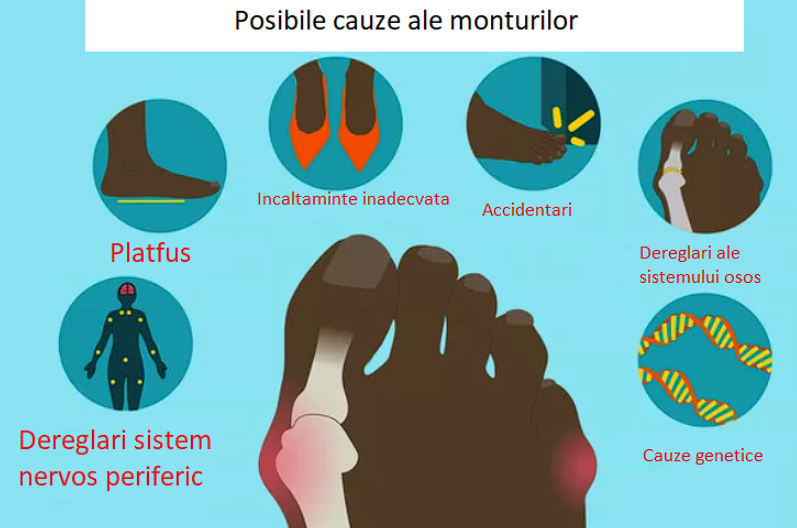 Hallux valgus: Simptome, cum se pune diagnostic, metode de tratament