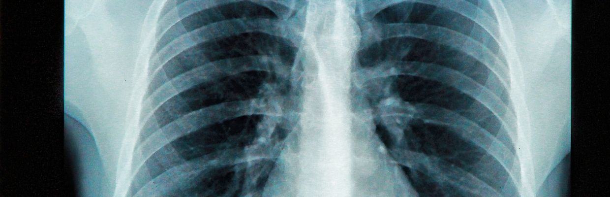 Dextrocardia: Ce inseamna, cum se poate trata