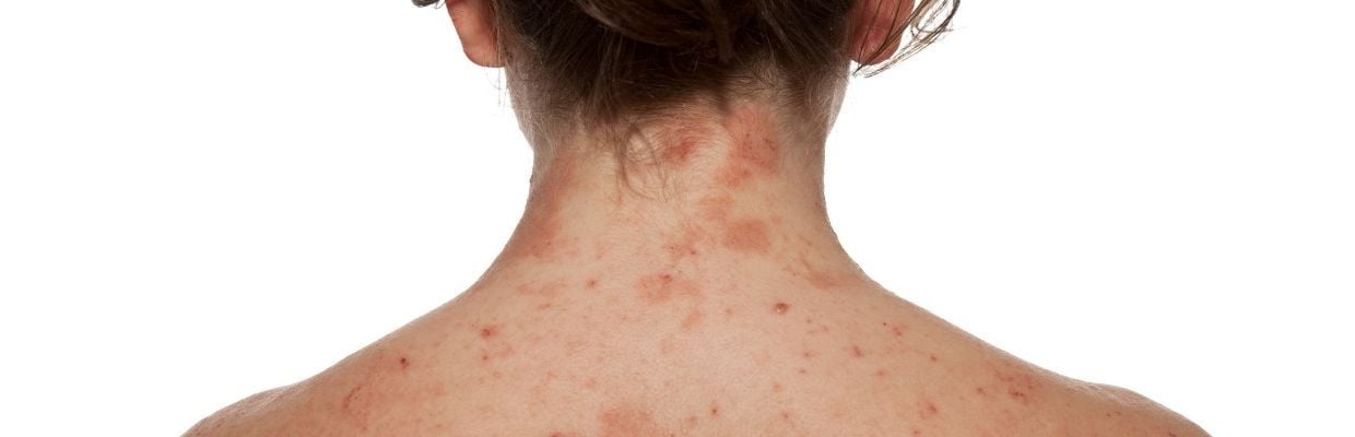 Dr. Teodora Predescu: 10 sfaturi de urmat in dermatita atopica