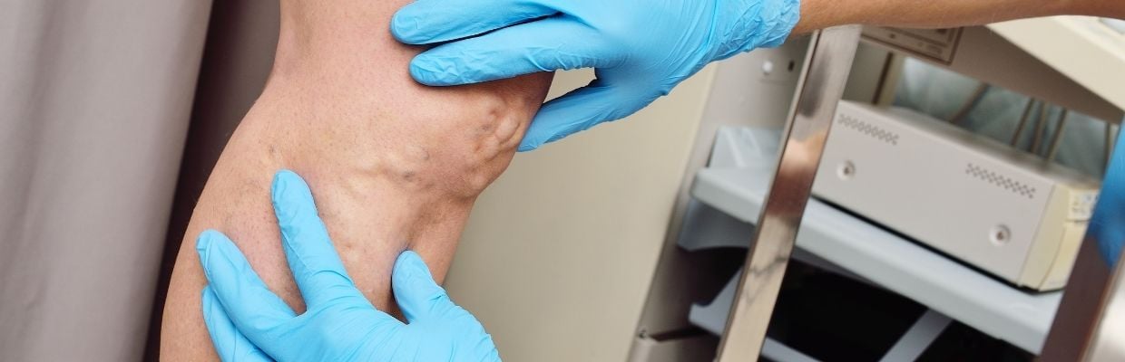 Flebita sau tromboflebita - despre inflamatia peretelui venos