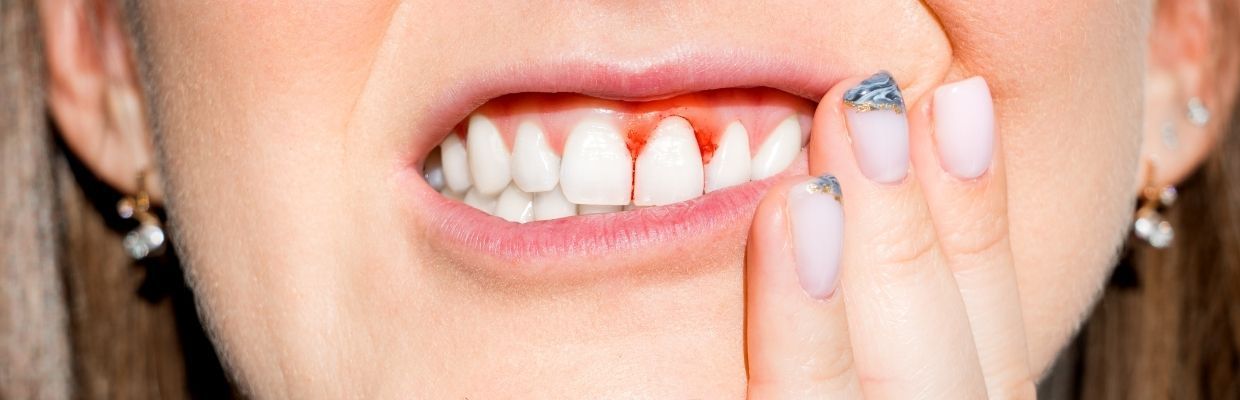 Gingivita: ce este, cauze, simptome si preventie