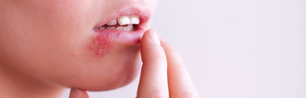 Herpesul oral: cauze, transmitere si metode de tratament