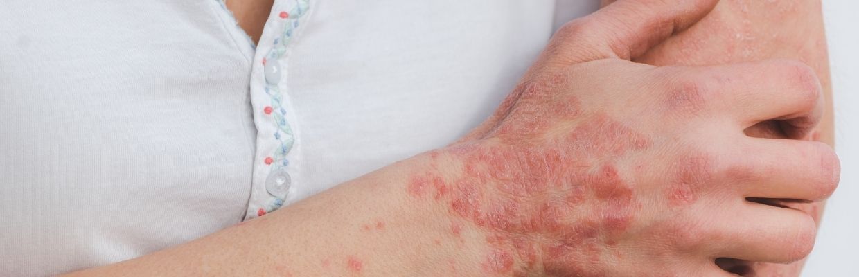 Psoriazis: cum arata, de ce apare si cum se trateaza