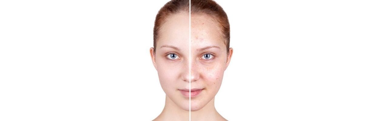 Remedii naturale contra acneei. Cum le alegi