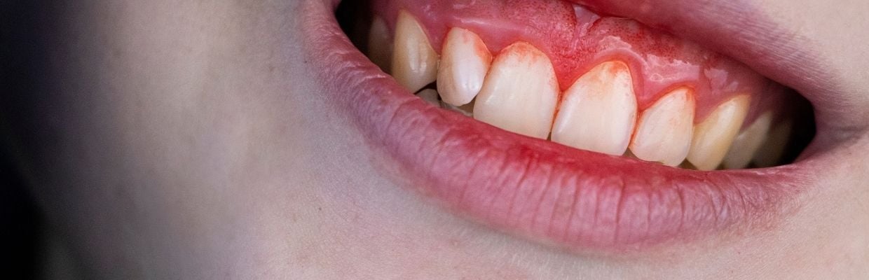 Sangerari gingivale la periaj: cauze si tratament