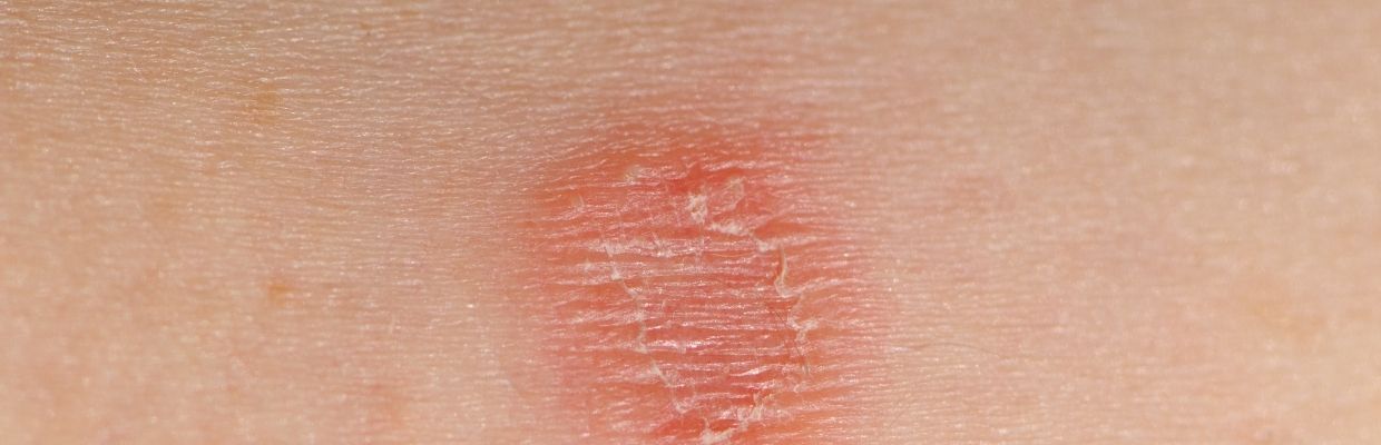 Tinea versicolor - ce este, cauze, simptome, tratament