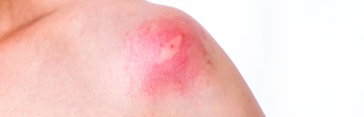 Muscaturile de insecte: cum le diferentiem, metode de preventie si tratament