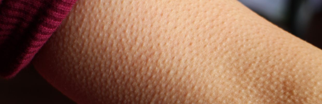 Keratoza pilara: cauze, simptome, remedii, secrete ale pielii